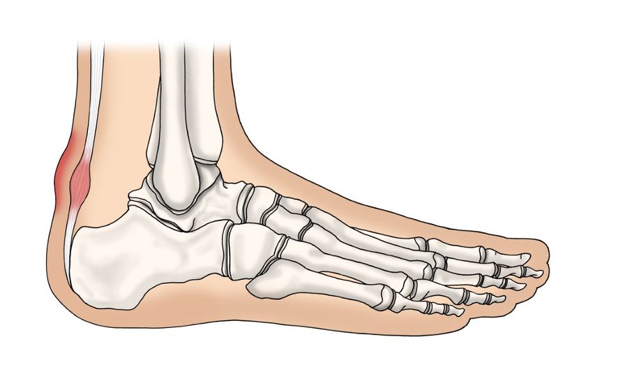 Gicht an der Ferse (Achillessehne): Symptome und Behandlung