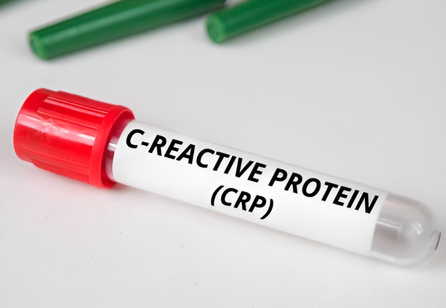 C‑reaktives Protein (CRP) bei Gicht
