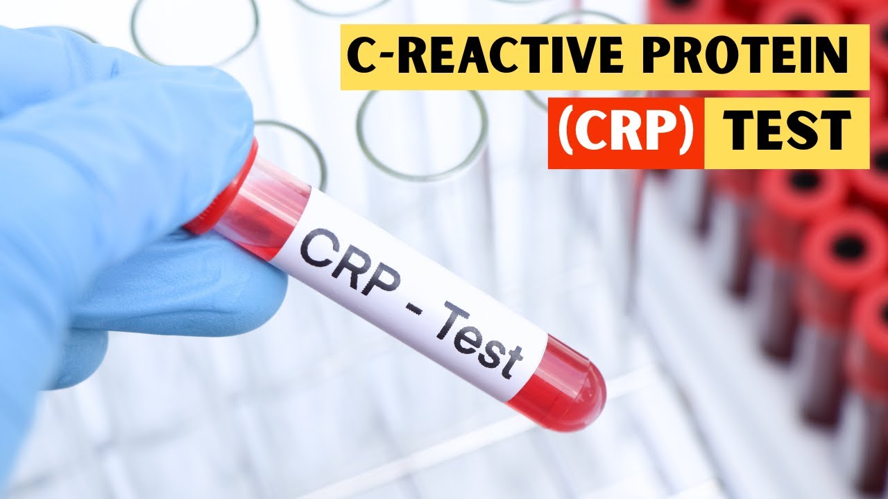 C‑reaktives Protein (CRP) bei Gicht