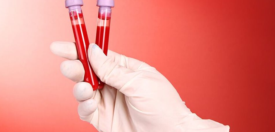 Glukose (Glc) bei der Diagnose und Überwachung von Gicht